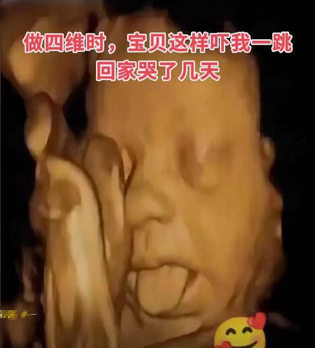 B超里胖胎宝直吐舌头，老公直呼可爱！医生一句话让夫妻崩溃了 - 2