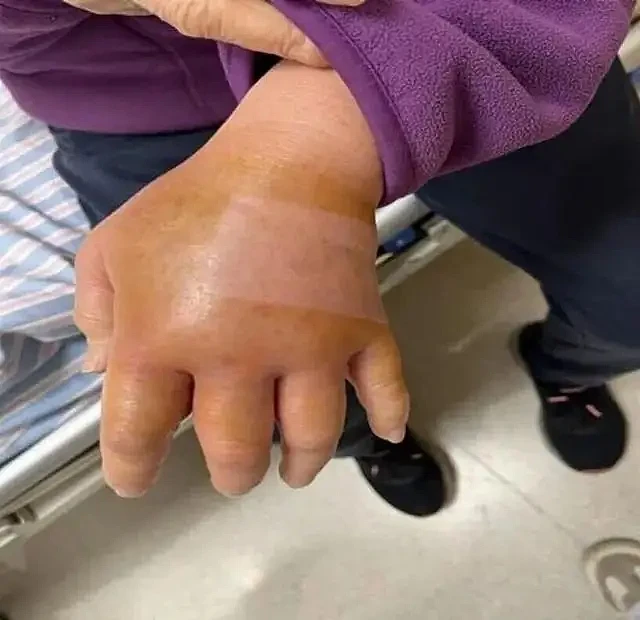 上海七旬阿姨被鱼刺扎手后，高烧39.7°C...（组图） - 1