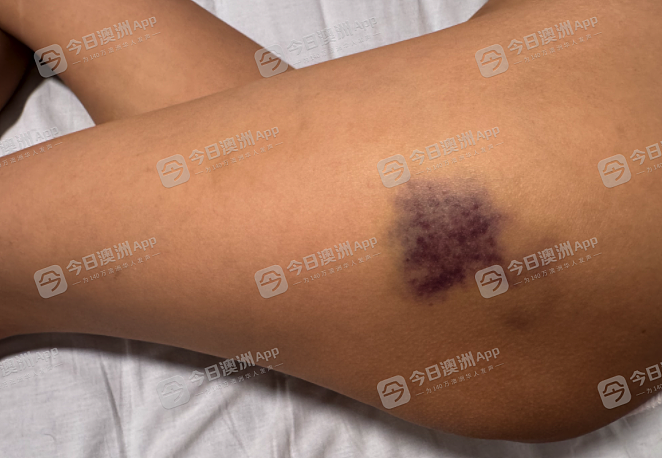 “她把我狠狠摔了出去！”澳洲华女华人区当街遇袭，报警仍被反复追打！批警方不力，华人副市长已跟进（视频/组图） - 1