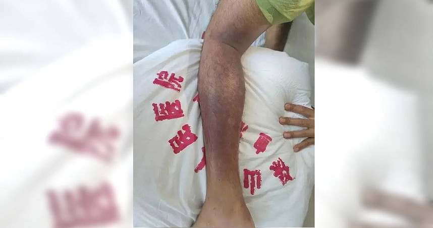 误踩蛇窝遭狂咬！男事发1小时后休克昏迷，医护人员急救一看伤口傻了（图） - 1