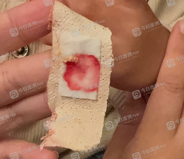 “差点伤到神经！”悉尼3岁华童幼儿园内割伤手指，接受全麻手术！家长质疑园方推责，后者回应：“处理符合要求”（视频/组图） - 2