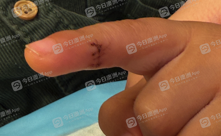 “差点伤到神经！”悉尼3岁华童幼儿园内割伤手指，接受全麻手术！家长质疑园方推责，后者回应：“处理符合要求”（视频/组图） - 5