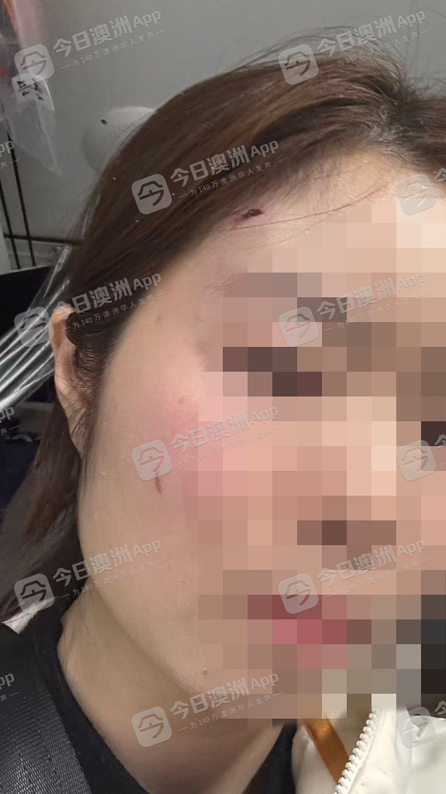 WHV华女抵澳不足一月即遇袭,无端遭拳击头部送院治疗!“原以为这里是安全的”(视频/组图) - 2