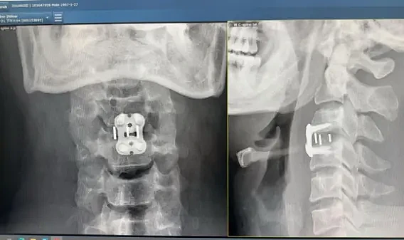 男子按摩正骨胸部以下瞬间失去知觉，可能终身残疾（图） - 1