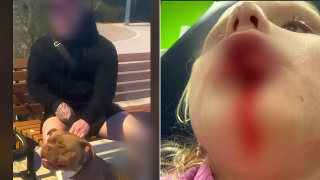 澳洲4岁女童在公园惨遭比特犬严重咬伤面部!肇事狗主竟当场逃逸 - 1