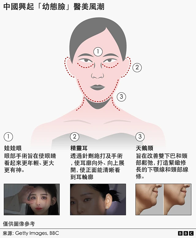 “幼态脸”、“精灵耳”与“天鹅颈” 台湾人为何开始到上海“跨境医美”?（组图） - 2