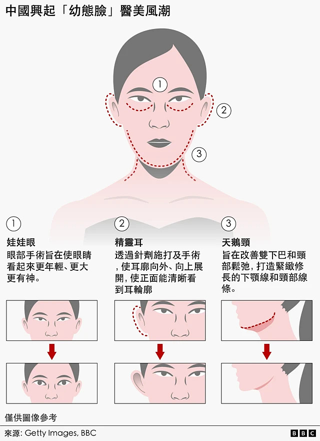 “幼态脸”、“精灵耳”与“天鹅颈” 台湾人为何开始到上海“跨境医美”?（组图） - 10
