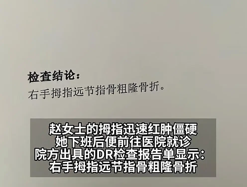 一女子被小米SU7电吸门夹手指致骨折,小米回应(组图) - 2