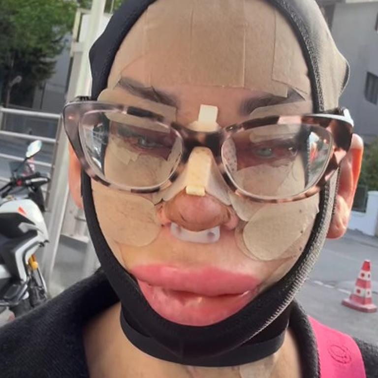 澳女花$1.7万赴土耳其整容,术后眼睛无法闭合!坚称“不后悔” - 7