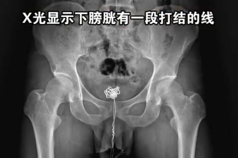 太扯！中国男子“25公分传输线”塞尿道，卡12小时痛到挂急诊 - 1