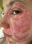 活该被烫伤？澳洲10岁女孩加热网红玩具致爆炸毁容！父亲发帖警示反遭网暴