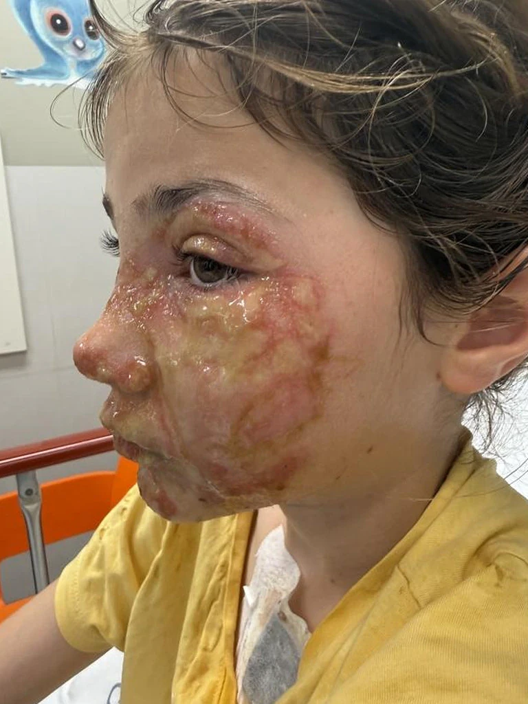 活该被烫伤？澳洲10岁女孩加热网红玩具致爆炸毁容！父亲发帖警示反遭网暴 - 2