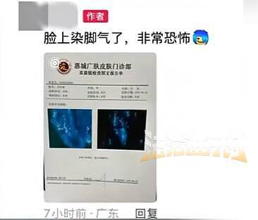 广东男子健身后脸上长“脚气”，直呼太恐怖！网友分享中招经历：屁股长一片痘痘（组图） - 1
