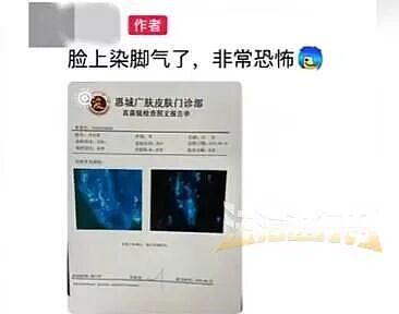 广东一男子健身后脸上长“脚气”，直呼太恐怖 - 1