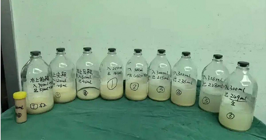 罕见！武汉6岁女童狂咳两月，肺部灌洗出3升牛奶状液体 - 1