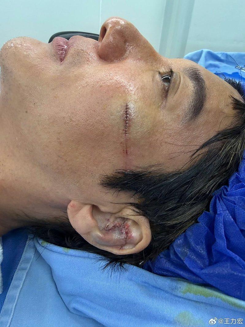 应该很痛…王力宏台上重摔画面疯传，撞碎耳软骨缝39针（视频/组图） - 2