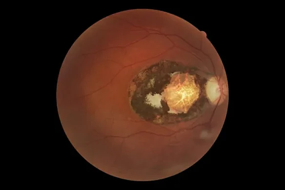 全球近1/3人口感染,无药可治!澳专家:这招能救命 - 3