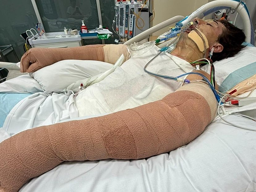 扫地机器人爆炸!珀斯25岁男子全身75%烧伤,命悬一线(组图) - 4