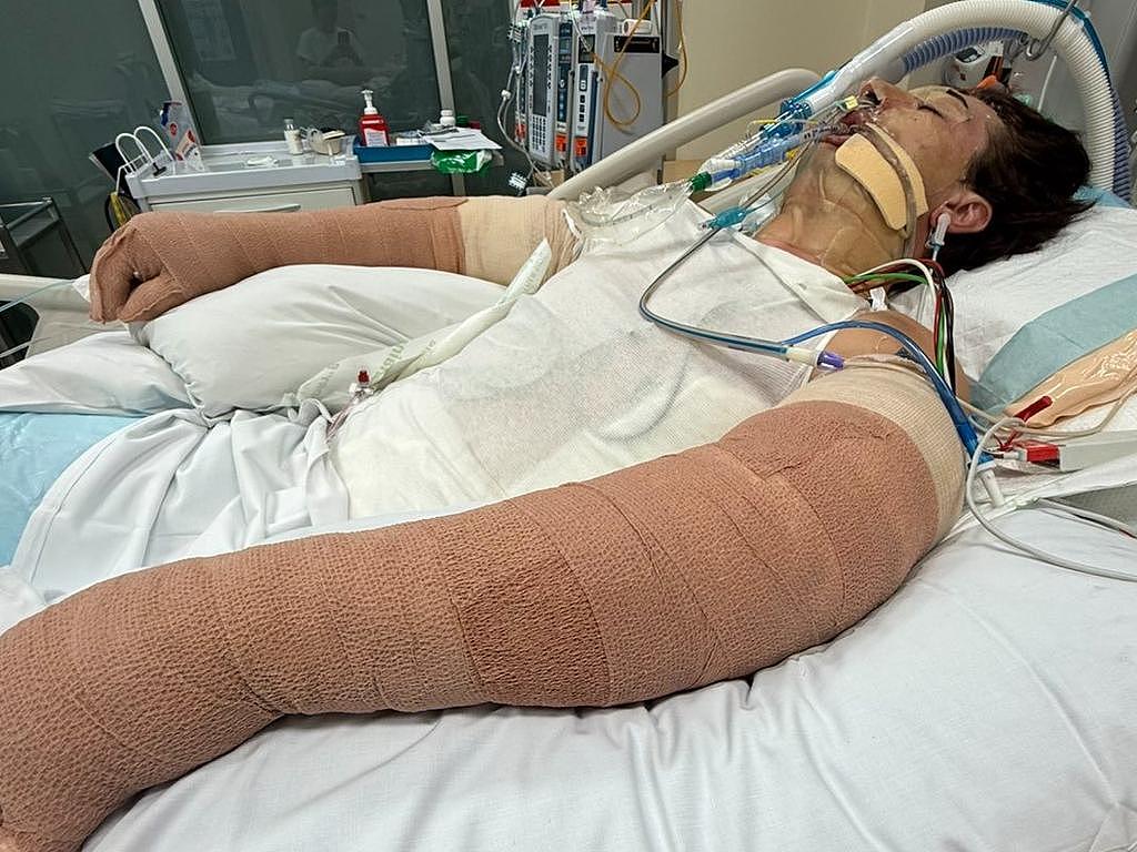 扫地机器人突然爆炸,致七成皮肤烧伤!澳男命悬一线 - 4