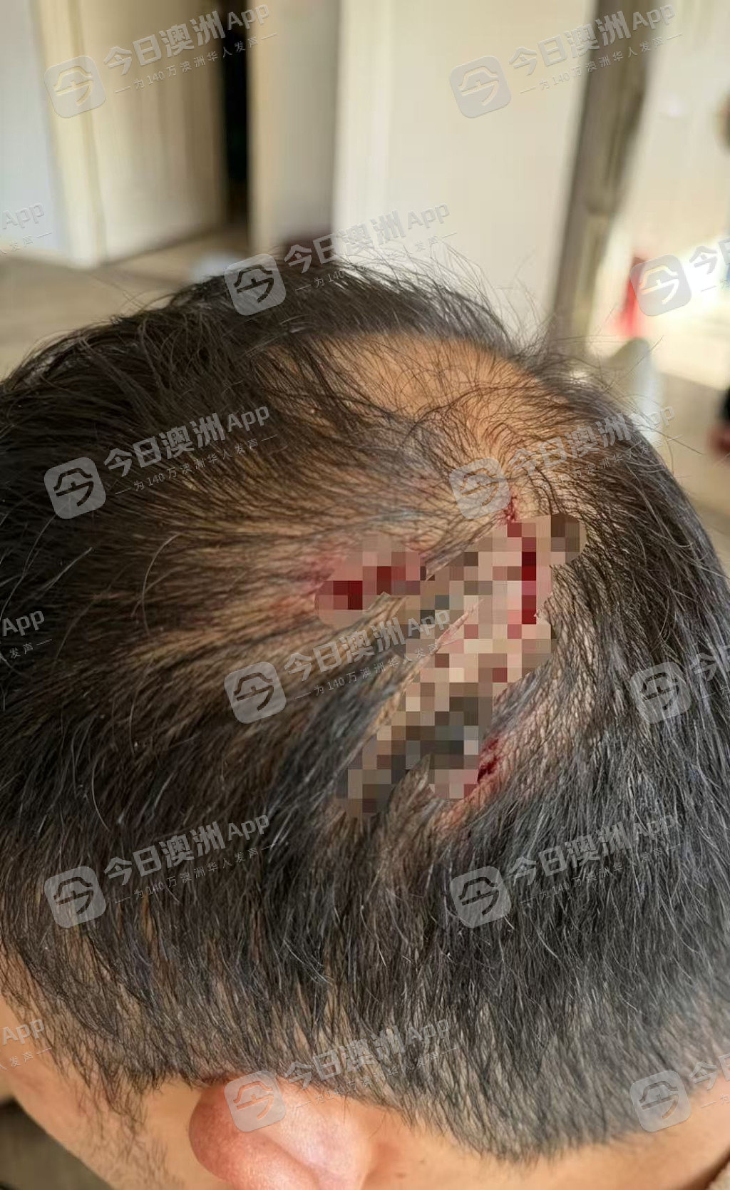 “招招致命!”澳洲华人店主无端遭凶狠围殴,头破血流遍体鳞伤!批警方不作为,华人食客暖心声援(组图) - 5