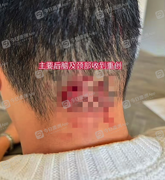 “招招致命!”澳洲华人店主无端遭凶狠围殴,头破血流遍体鳞伤!批警方不作为,华人食客暖心声援(组图) - 11