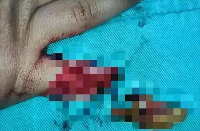 “爸爸我的手指没了” 安徽2岁女童坐滑梯夹断小拇指，辗转三地连夜接指（组图） - 2