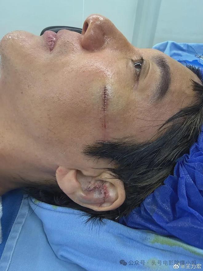 王力宏血染舞台缝39针！陈奕迅曾撞伤下体，这些演唱会事故太邪门 - 4