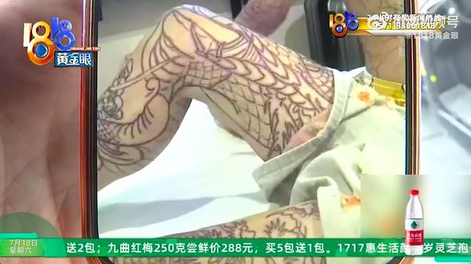 14岁少年双腿文成“大花腿”，家长索赔20万元（组图） - 1