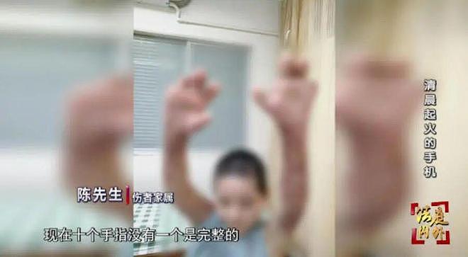 女子卧床边充电刷手机被严重烧伤,十指无一完整,法院判销售商赔63万 - 2