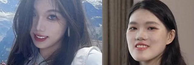 24岁女孩做正颌手术反成“鞋拔子脸”:恢复要花30万;卫健委介入 - 1