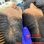  专业治疗 脱发  生发 秃头 地中海 头皮护理修复 鸡皮肤治疗 疤痕修复 