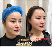 医美 线雕 除皱 瘦脸针 超声刀  皮秒祛斑 祛痘 减肥溶脂