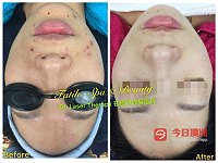  口碑专业 治痘 修复痘疤痘坑  肌底清洁去黑头 减肥瘦身 产后修复 