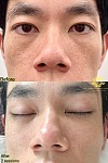  澳洲持牌合法操作镭射微针 专业祛痘修复痘印 祛斑 去黑头收缩毛孔 深层净肤