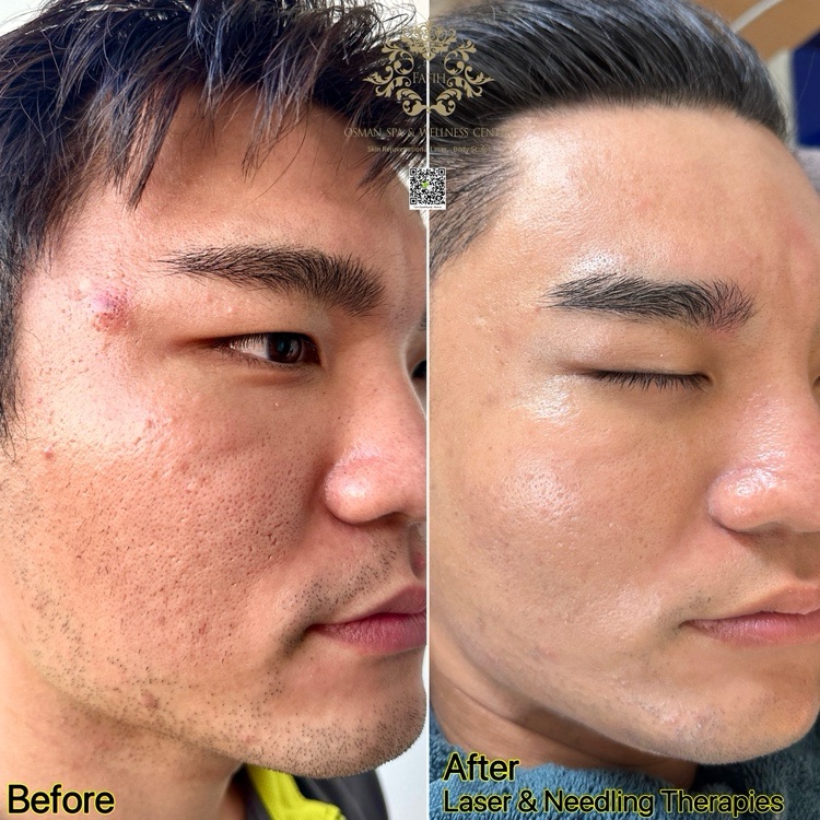 今日悉尼 澳洲持牌合法操作镭射微针 专业祛痘修复痘印 祛斑 去黑头收缩毛孔 深层净肤 澳洲持牌合法操作镭射微针 专业祛痘修复痘印 祛斑 去黑头收缩毛孔 深层净肤