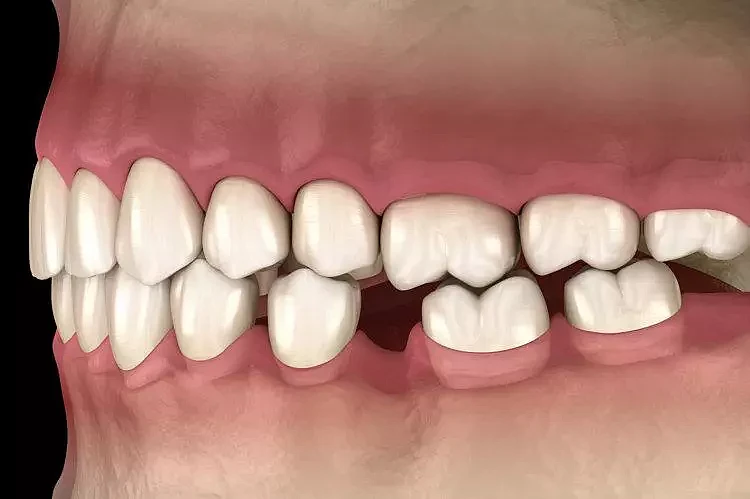 【养生】掉牙和寿命有关？60岁之后，牙齿剩多少颗才正常？看看您达标了吗（组图） - 5