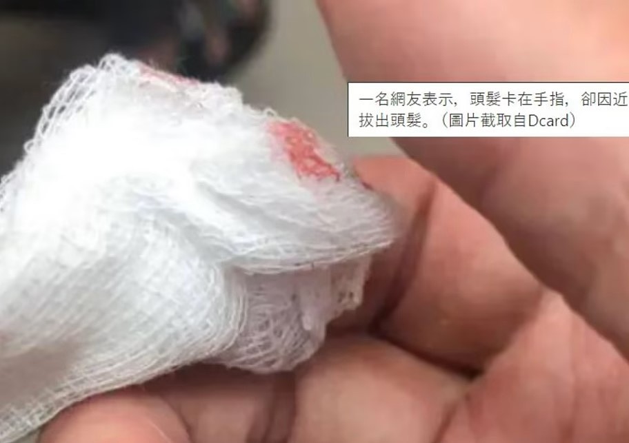 头发扎到手指，台湾男生四天后化脓最严重恐截肢（组图） - 1