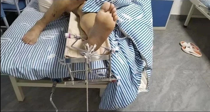 中国小伙缅北逃亡记：逃跑时从五楼坠落摔断腿，在医院被枪指着头威胁（组图） - 3