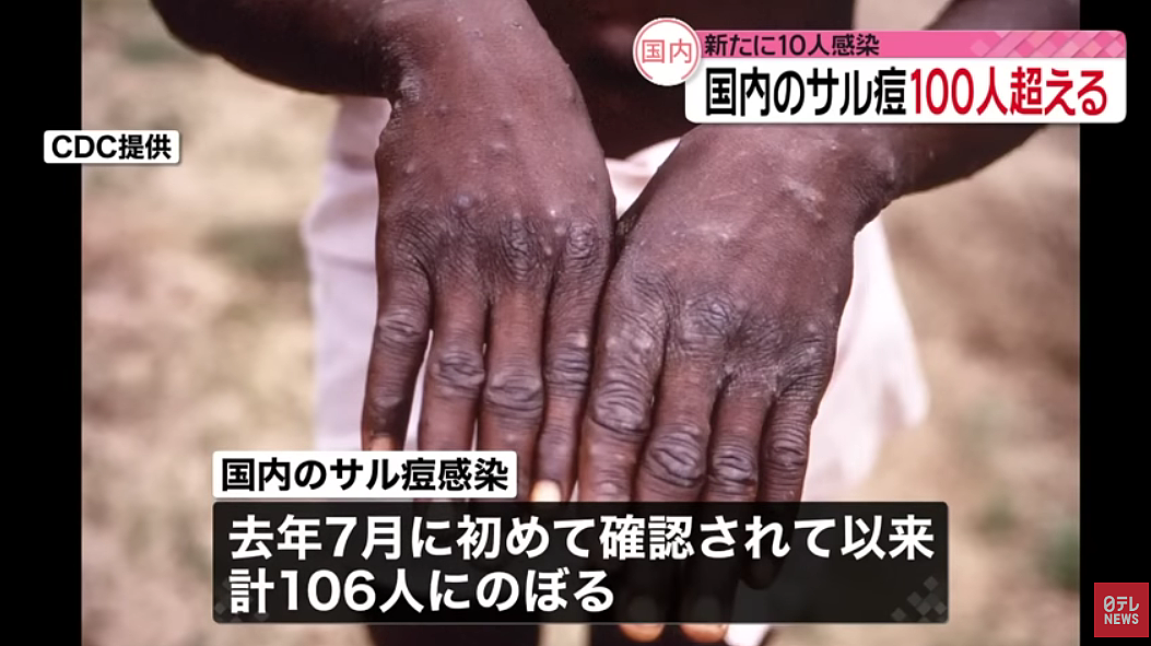 警惕！日本猴痘感染者突然增加，猴痘病毒感染人数超86000，发疹或有水泡要及时就医（组图） - 4