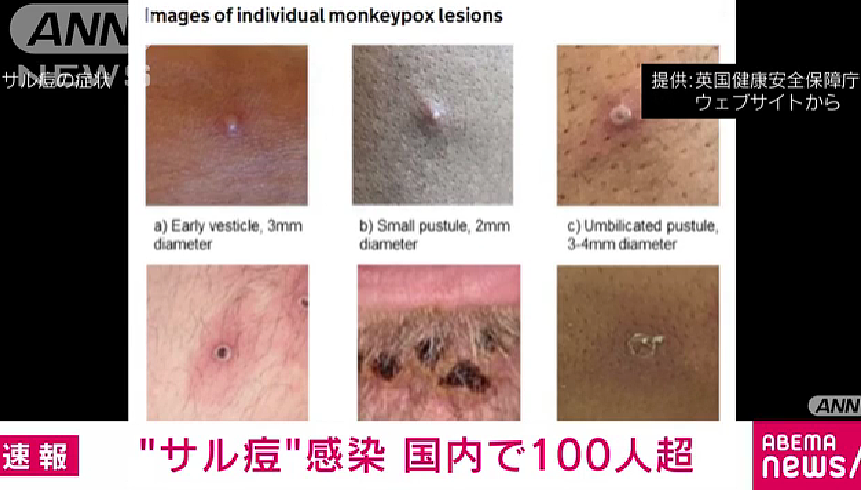 警惕！日本猴痘感染者突然增加，猴痘病毒感染人数超86000，发疹或有水泡要及时就医（组图） - 2