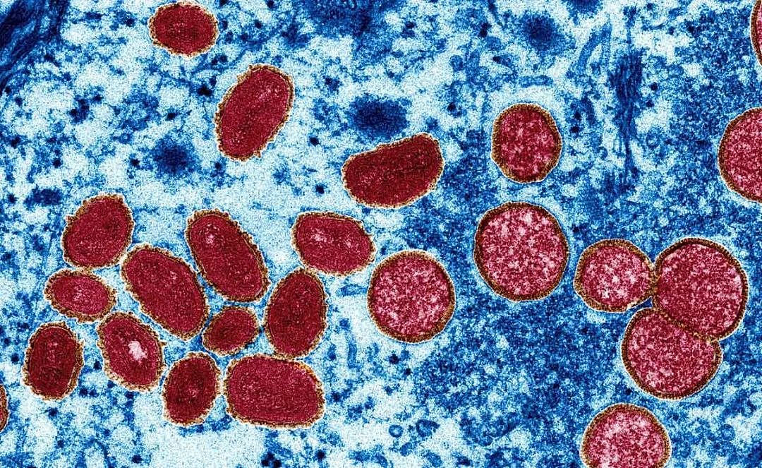 警惕！日本猴痘感染者突然增加，猴痘病毒感染人数超86000，发疹或有水泡要及时就医（组图） - 6