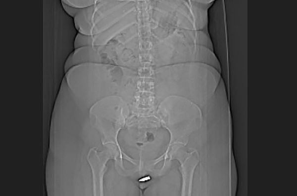 外科杂志：私处取2cm子弹，史上首例！女子下体中流弹，紧急送医后发现子弹卡阴蒂（图） - 1