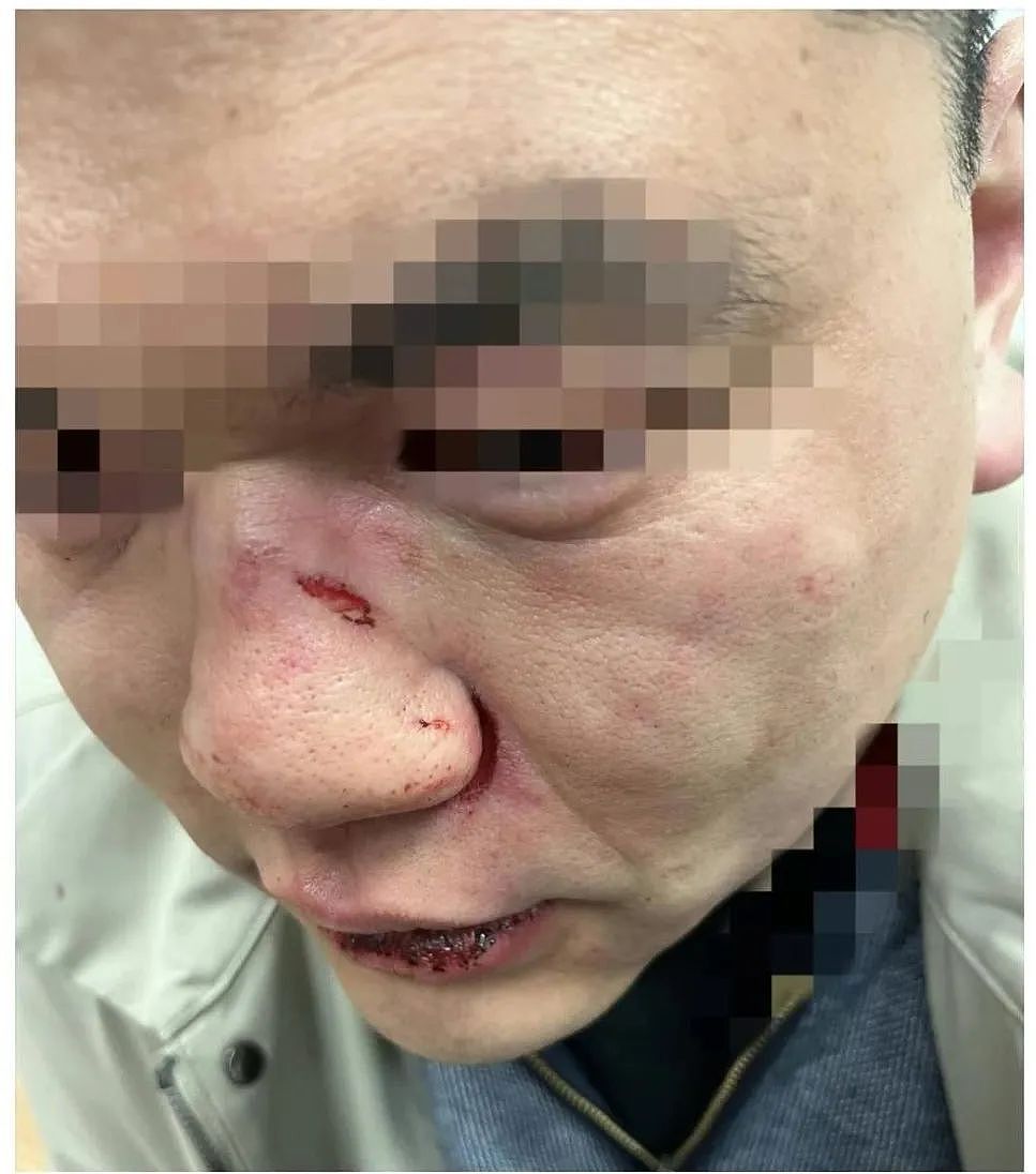 中国留学生伦敦地铁遭非裔重拳袭击： “我满脸鲜血“！ 行凶者竟被保释？（组图） - 1