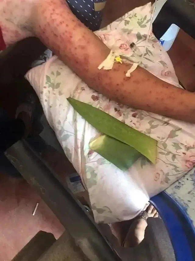 尼加拉瓜6人被蜂蜇后遇难！公交坠崖撞蜂巢，皮肤上满是“针眼”（组图） - 3