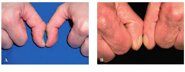 手指出现这个变化，是身体发出的危险信号！1个简单方法，赶紧自查（组图） - 6