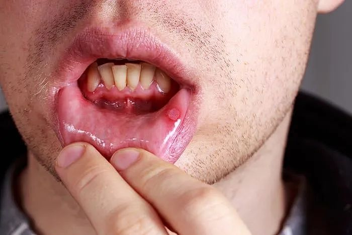 是癌！男子“口腔溃疡“ 被洗牙师救了一命，这症状大家都有，千万小心（组图） - 11