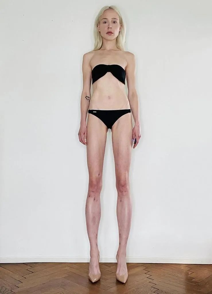 德国模特为长高14cm做手术“打断”腿两次，花费上百万！网友：接受不了（组图） - 3