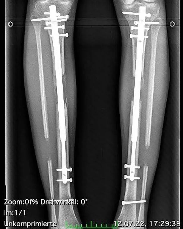 德国模特为长高14cm做手术“打断”腿两次，花费上百万！网友：接受不了（组图） - 9