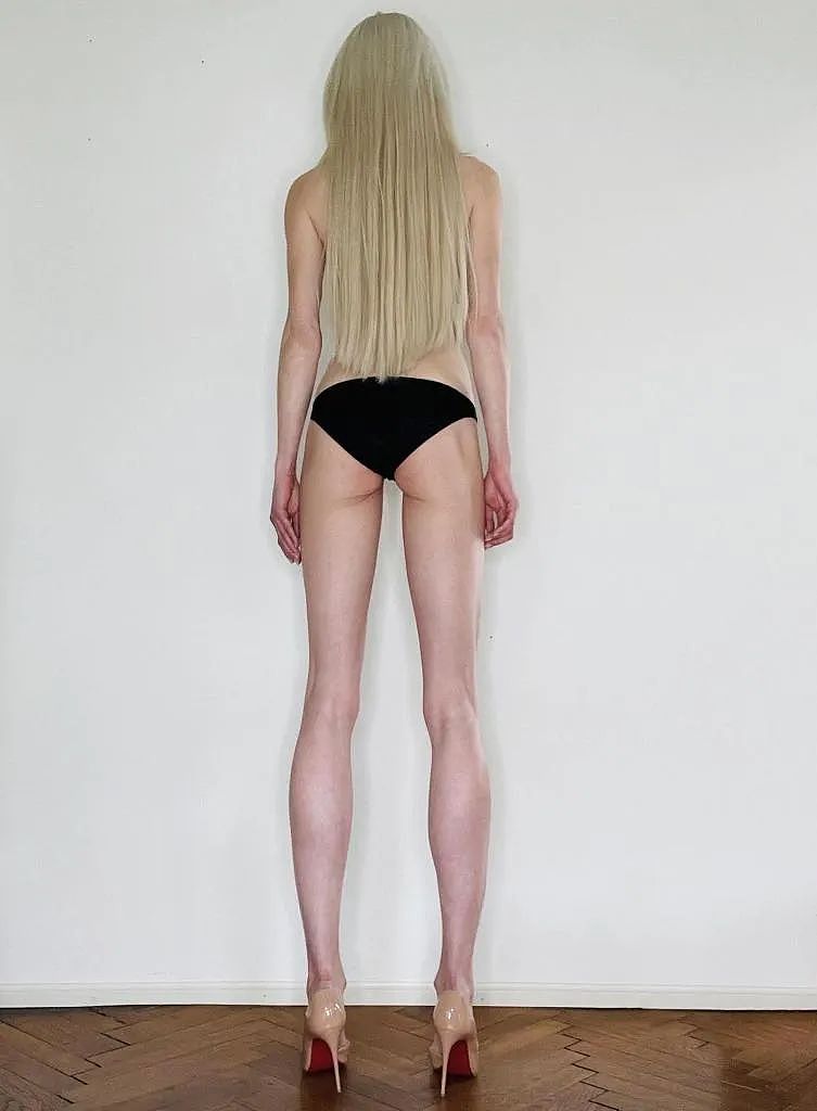 德国模特为长高14cm做手术“打断”腿两次，花费上百万！网友：接受不了（组图） - 2