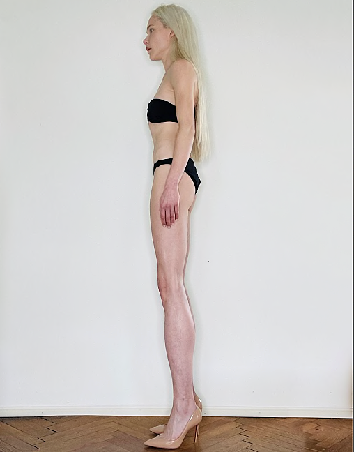 德国模特为长高14cm做手术“打断”腿两次，花费上百万！网友：接受不了（组图） - 1